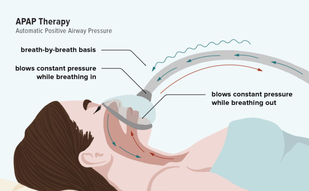 CPAP