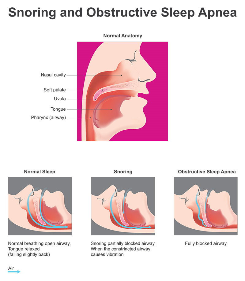 Sleep Apnea