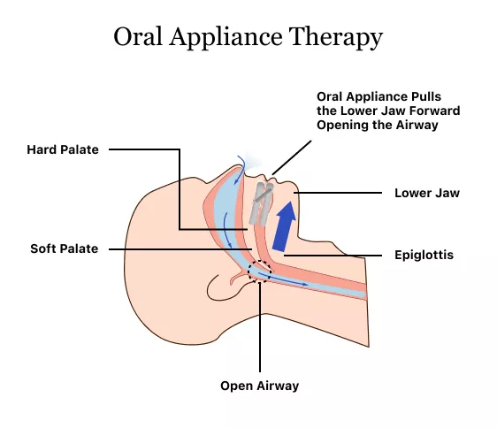Oral Appliance Therapy/ Mandibular Advancement Devices